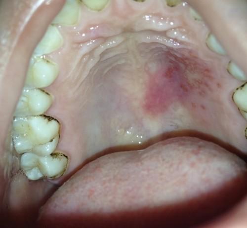 口腔上颚溃疡怎么治疗